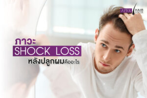 ภาวะshock loss ผมร่วงหลังปลูกผม 300x200