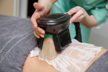 depositphotos 237831696 stock photo beauty therapist applying cryolipolysis treatment