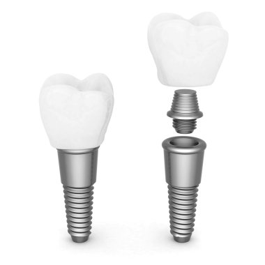 depositphotos 30310515 stock photo dental implants