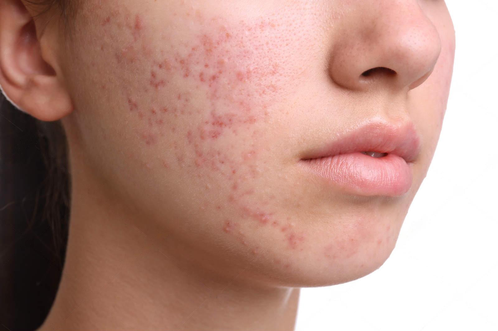 Acne scars