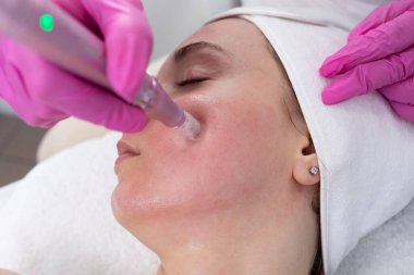 Acne scars with laser