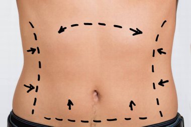 depositphotos 673148670 stock photo close man abdomen correction lines