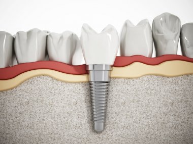 depositphotos 98045052 stock photo dental implant detail